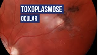 Toxoplasmose Ocular [upl. by Llekcir]