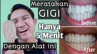 CARA MERATAKAN GIGI TANPA BEHEL [upl. by Silsbye]