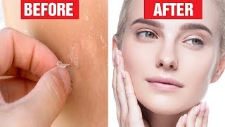 8 Best Ways to Get Rid Of Peeling Skin on Face [upl. by Dyane453]