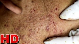 HD EXTREME BLACKHEADS Extraction 5 [upl. by Laeria326]