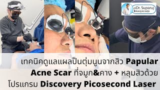 รักษาแผลป็นตุ่มนูนจากสิว Papular Acne Scar ที่จมูกampคาง  หลุมสิว ด้วย โปรแกรม Discovery Pico Laser [upl. by Ynnor]