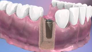 Implantes dentales  BQDC  Qué son cómo se colocan [upl. by Casady]