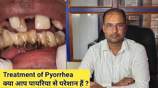 What is pyorrheaTreatment of pyorrhea  क्पा होता है पायरिया  पायरिया का इलाज  medical dental [upl. by Ennayhc]