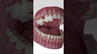 Digital Dental Implant Workflow dentist custom [upl. by Barbra]