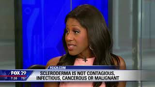 What is Scleroderma What Are the Symptoms of Scleroderma A Doctor Explains [upl. by Zelde]