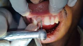 Non Vital Toot Treatment Part 2  Easy Ceramic Crown Preparation  PFM Crown Preparation [upl. by Cirdec155]