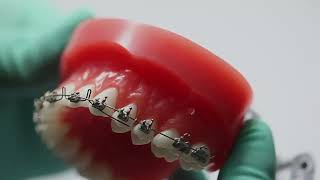 Orthodontic Anterior Torquing Auxiliary Arch [upl. by Armington844]