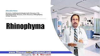 Rhinophyma  Causes Diagnosis Symptoms Treatment Prognosis [upl. by Sprage615]