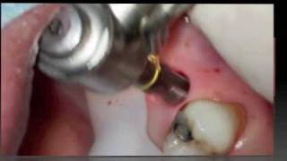 Implant flapless surgery [upl. by Diogenes]