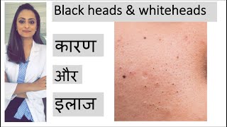 blackheads whiteheads treatment  ब्लाक हेड्ज़ को कैसे निकाले  त्वचा के डॉक्टर [upl. by Aytac]