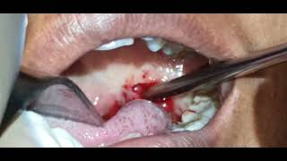 Quinsy  Peri tonsillar abscess  I and D  Dr Hitesh Patel [upl. by Ennaesor]