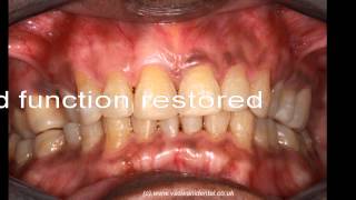 Generalised advanced teeth wear TSL restoration by Vaswani Dental at Southgate London N14 [upl. by Jeavons]