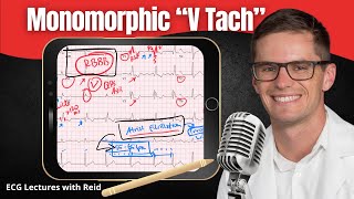 Monomorphic Ventricular Tachycardia VT EKG  ECG Lecture [upl. by Eigna]