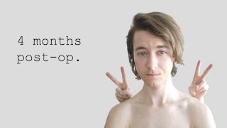 ftm 4 months postop [upl. by Weston]