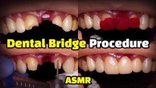 Dental Bridge Procedure [upl. by Swayne]