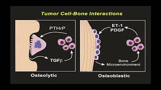 Metatastic Bone Disease  Dr Aubrey Stoch [upl. by Ahseral826]