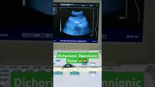 Dichorionic Diamnionic twins pregnancy 🥰🥰😍😍shortyoutubevideo plzzsubscribe babyultrasound [upl. by Handy]