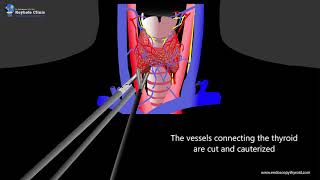 Endoscopic Thyroidectomy [upl. by Einnoc840]