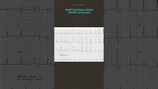 ECG Diagnosis [upl. by Erbua]