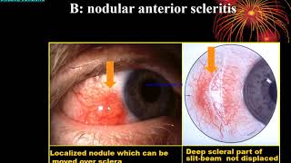 Sclera Lect By Dr Abdul Basir Safi 1 [upl. by Crissy]