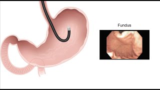 HCC 14753b  Stomach  Endoscopy findings of normal anatomy [upl. by Sheffield]