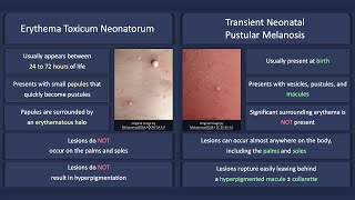 Erythema Toxicum Neonatorum vs Transient Neonatal Pustular Melanosis [upl. by Llemart]