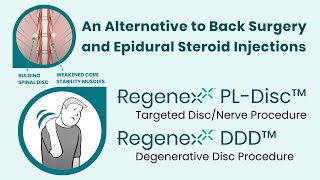 Regenexx PLDisc Avoid the Harmful Side Effects of Epidural Steroids and Back Surgery [upl. by Yoko2]