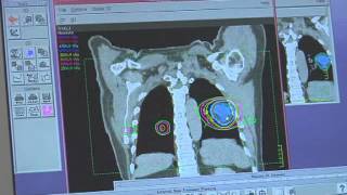 Cancer Treated with Radiation Therapy [upl. by Rasec]