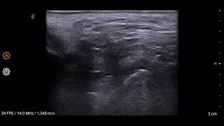 TMJ Ultrasound Disc Displacement with Reduction [upl. by Ahseinar]