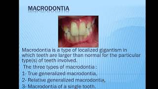 38Types of macrodontia [upl. by Poler]