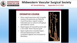 Open Bypass for rapid expansion of saccular left carotid aneurysm in Takayasus Arteritis Patient [upl. by Aikar]