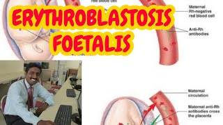 ERYTHROBLASTOSIS FOETALIS  TAMIL EXPLANATION [upl. by Entruoc]