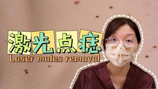 保姆级科普！激光点痣从治疗到护理Moles [upl. by Strade]