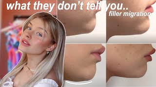 chin filler 3 years later  filler migration what they dont tell you [upl. by Skill]