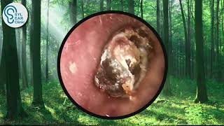 7 YEARS Untreated Impacted Ear Wax  SYL CLINIC [upl. by Freytag]