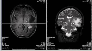 Brain Tumor mimic And Optic Tract [upl. by Ylnevaeh]