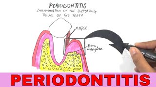 Periodontal Disease  Pathogenesis [upl. by Tillie]