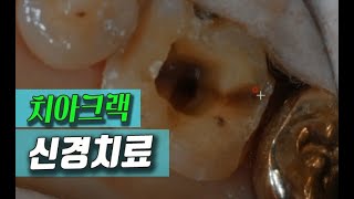 치아크랙 금간치아 신경치료후 크라운치료 [upl. by Kermy]