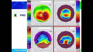 Quick guide to reading corneal tomography Part 6 [upl. by Zarla]