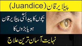 Jaundice Treatment At Home  Pela Yarkan Ka ilaj in Urdu  Hindi  Hepatitis Ka ilaj Tib e Nabvi [upl. by Lalittah413]