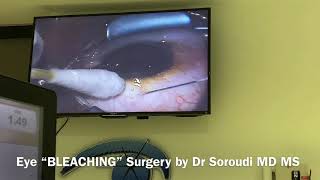 Eye Bleaching Surgery for Racial Melanosis Dr Ebbie Soroudi MD MS [upl. by Hinkel]