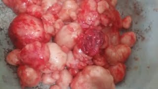 fibroids embolization is safe treatment as myomectomy [upl. by Noseaj]