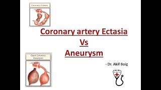 Coronary Ectasia Vs Aneurysm Dr Akif Baig [upl. by Ymiaj]