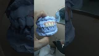 Valplast 4 gigi dentist doktergigi gigitiruan vidioshorts [upl. by Fleischer]