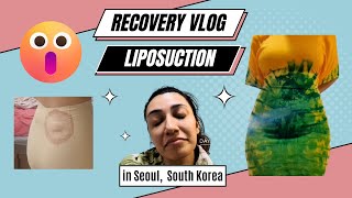 LAMS Liposuction  Week 1 recovery Vlog [upl. by Aiksa]