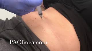 Lipolysis Injections Dr Sharabi PACBocacom [upl. by Elvin]