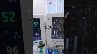 PRVC Mode in Ventilators Explained in 60 Seconds [upl. by Lachus719]