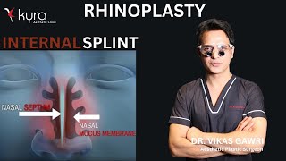 Internal Nasal splint after Rhinoplasty  Splint removal after Rhinoplasty  Kyra Aesthetic Clinic [upl. by Nylevol]