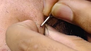 ASMR beard care ingrown hairs and removing pimple Hair ASMR Autonomous Sensory Meridian Response [upl. by Cadmarr]