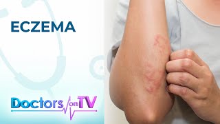 Eczema Symptoms Causes and Treatment  Doctors on TV [upl. by Solorac]